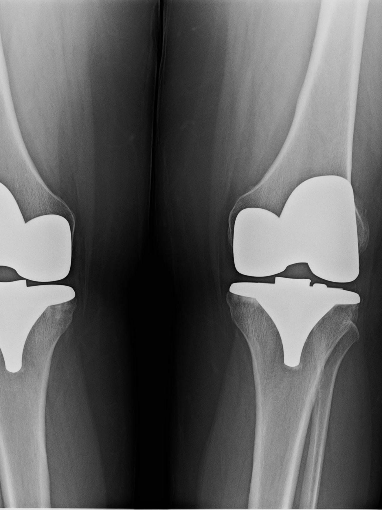 Bilateral Knee Replacement Recovery with X10 Therapy