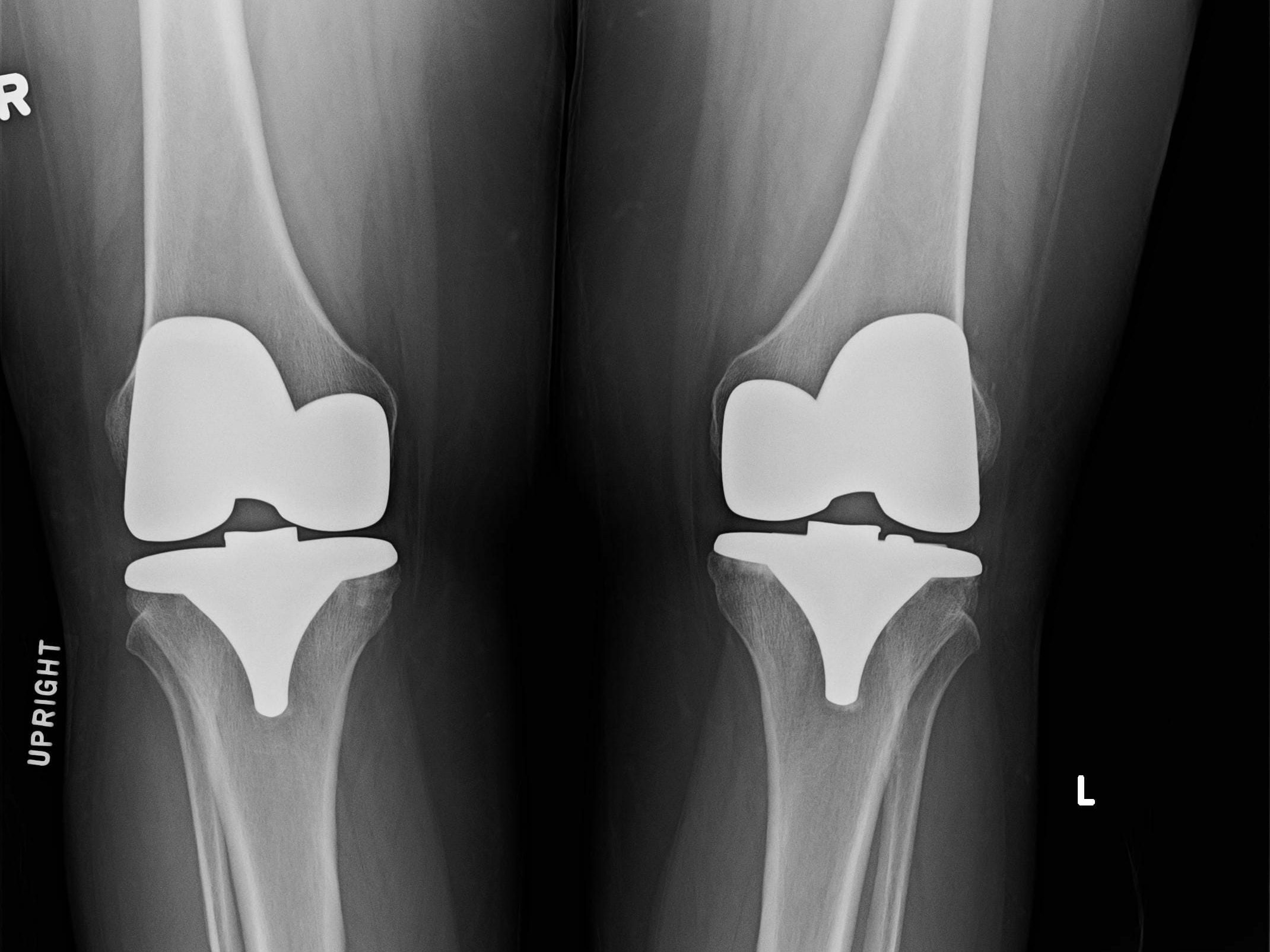 Bilateral Knee Replacement Recovery with X10 Therapy
