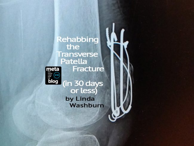 Transverse Patella Fracture