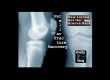 Patellar Fracture Recovery