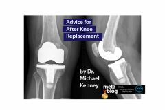 Advice After Knee Surgery