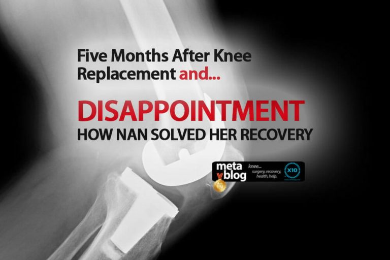 Five Months After Total Knee Replacement Five Months After Total Knee Replacement