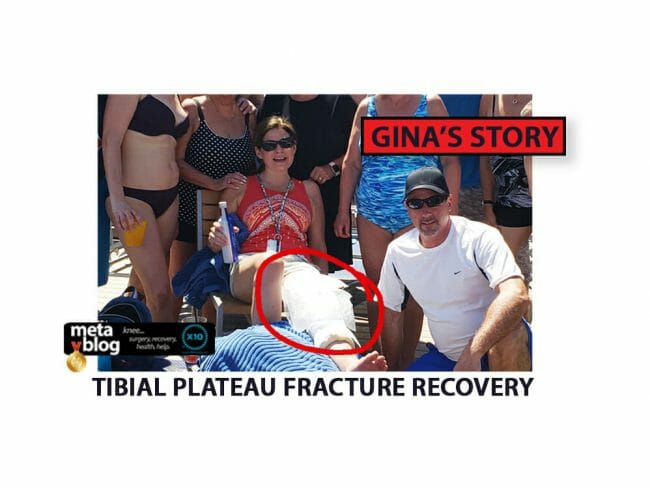 Tibial Plateau Fracture Recovery Tibial Plateau Fracture Recovery