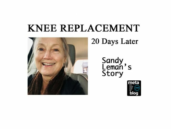 Knee Replacement 20 Days Later Knee Replacement 20 Days Later