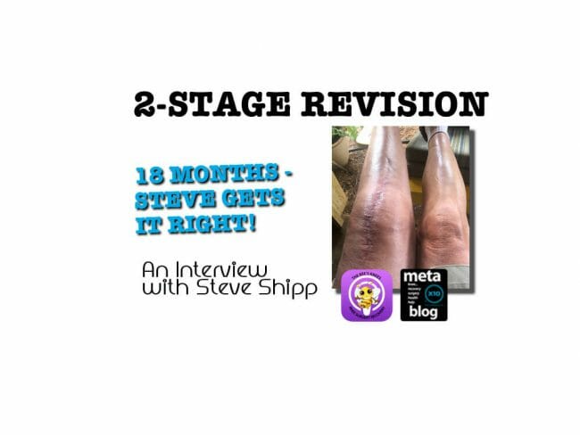 Two Stage Knee Revision