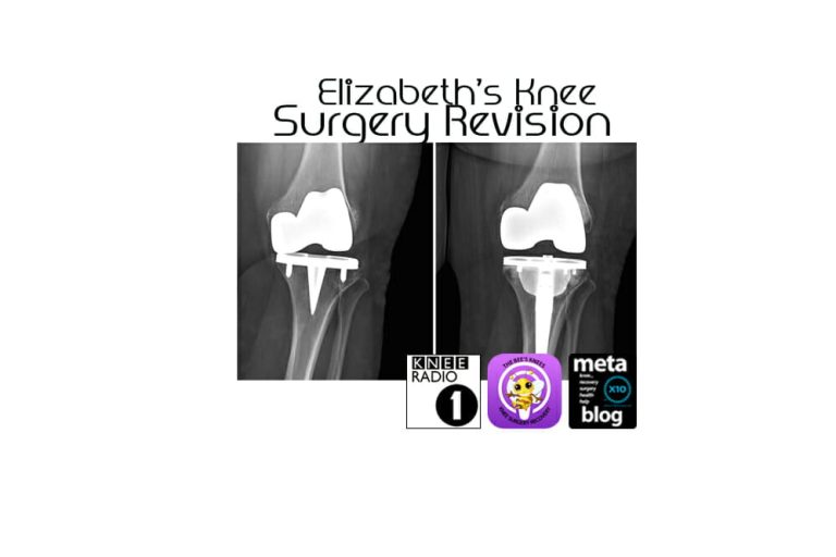 Elizabeth’s-Knee-Surgery-Revision
