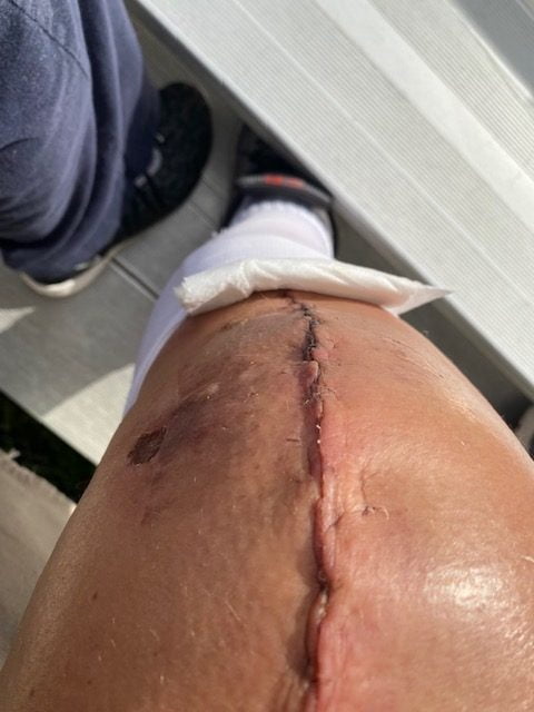 Patrick Brown Knee Surgery Recovery | The Bee's Knees Podcast Patrick Brown Knee Surgery Recovery | The Bee's Knees Podcast