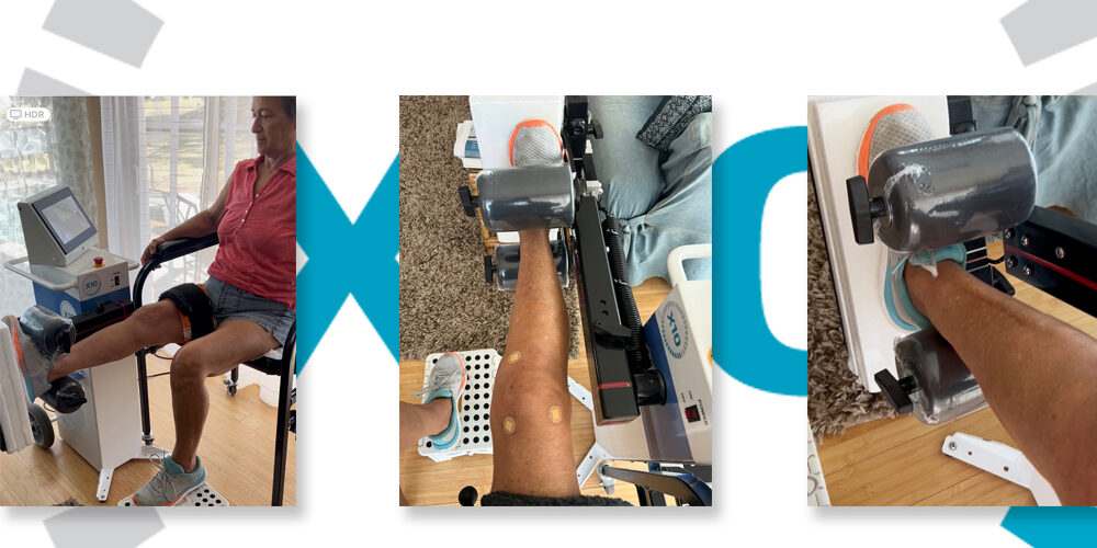 FEATURE-WOMEN-AND-KNEE-REPLACEMENT-RECOVERY FEATURE-WOMEN-AND-KNEE-REPLACEMENT-RECOVERY