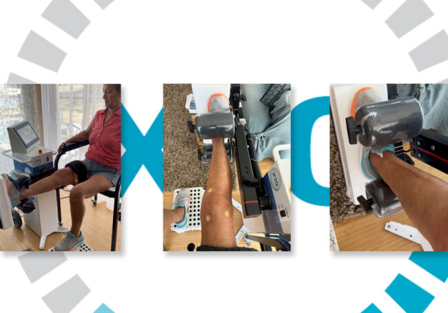 FEATURE-WOMEN-AND-KNEE-REPLACEMENT-RECOVERY