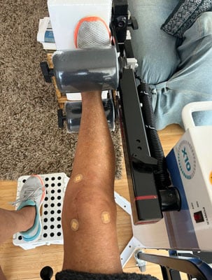 Susanna Ruden | X10 Therapy | Knee Replacement Recovery for Women